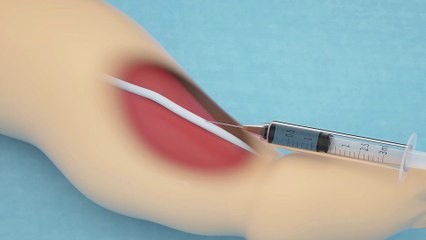 Practice Infant IV and Phlebotomy on the Simulation Leg