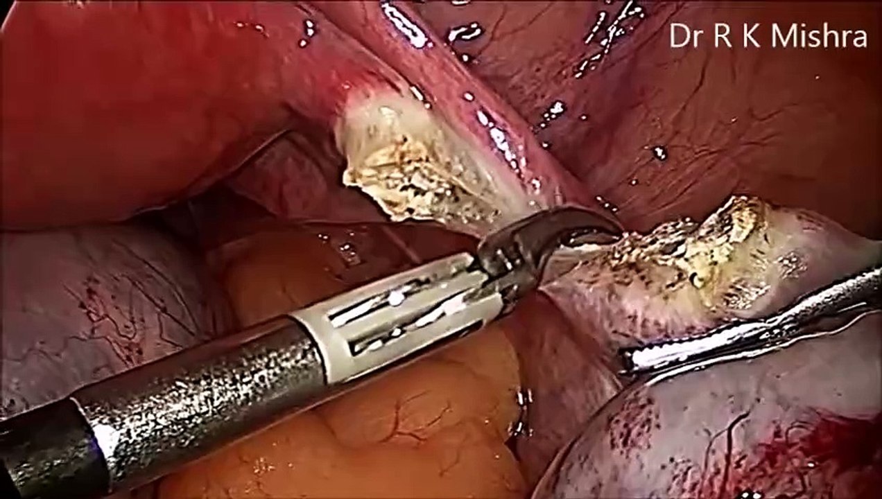 Bilateral Salpingooophorectomy