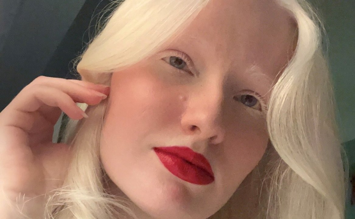 Bullied for being ALBINO but I've embraced my pale skin and white hair