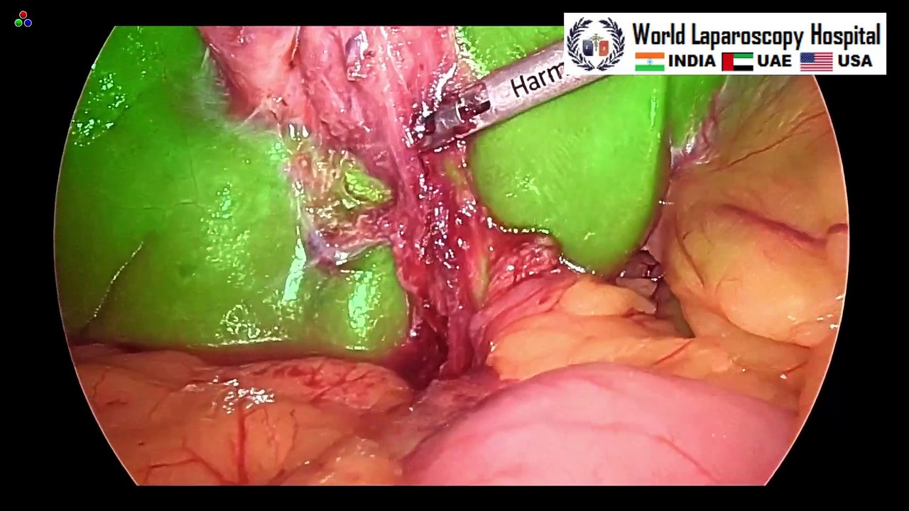 Cholecystectomy for Mucocele of Gallbladder