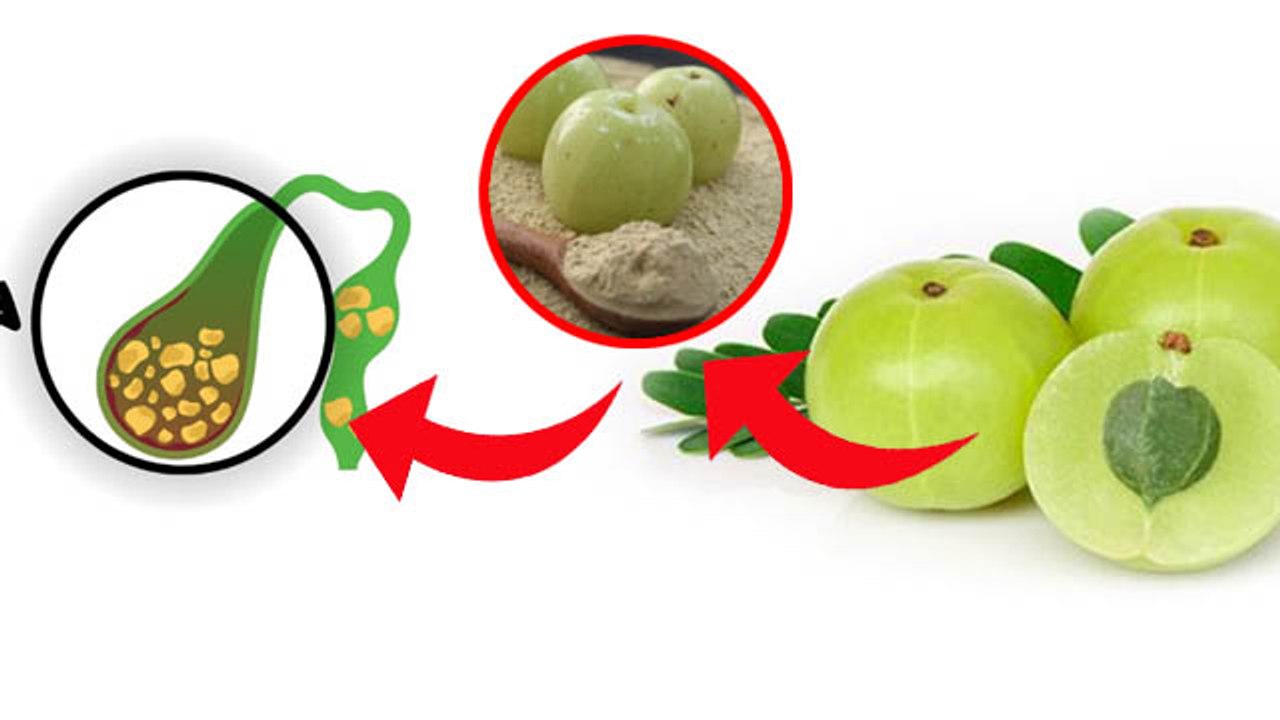 पित्त की पथरी कैसे ठीक होगी | पित्त की पथरी का बिना ऑपरेशन इलाज | Pitt Ki Pathri kaise Thik Kare