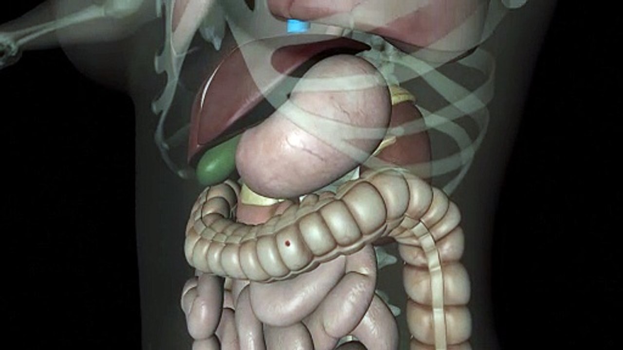 La endometriosis