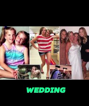 Abby and Brittany are conjoined twins who each have separate heads and share the same