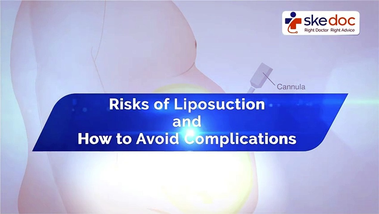 Risks Factors of Liposuction and How to avoid Complications? | Skedoc ...