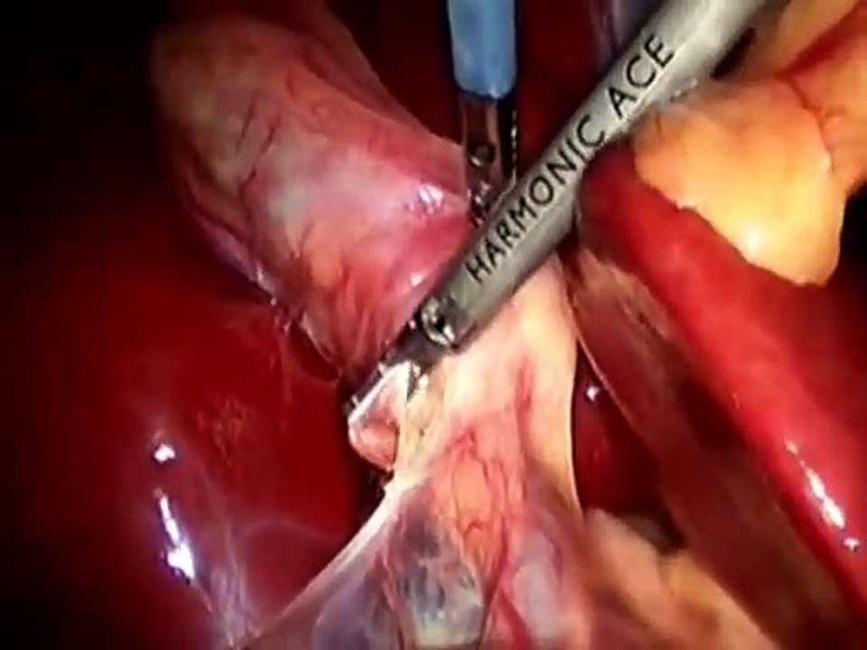 Clipless Laparoscopic Cholecystectomy