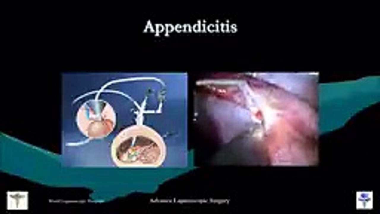 Pediatric Laparoscopy Lecture by Dr R K Mishra