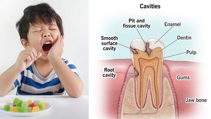 Deciduos Teeth Infection के बाद इलाज क्यों कराना चाहिए | Milk Teeth Infection Treatment In Hindi