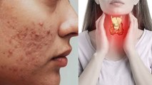Thyroid Se Pimples Badhte Hai Kya | Acne Due To Thyroid Reason In Hindi|Boldsky