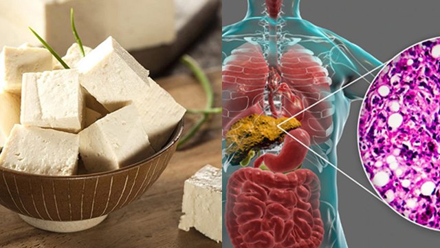 Fatty Liver Me Paneer Kha Sakte Hai | Fatty Liver Me Kya Khana Chahiye | Boldsky