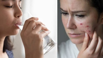 क्या ज्यादा पानी पीने से मुहासे दूर हो सकते हैं | Does Drinking Water Help With Acne | Boldsky