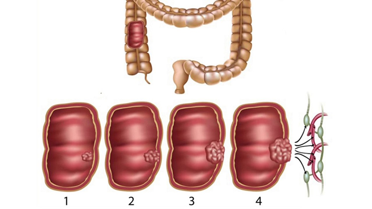 bd-prevencion-y-deteccion-temprana-del-cancer-de-colon-010424
