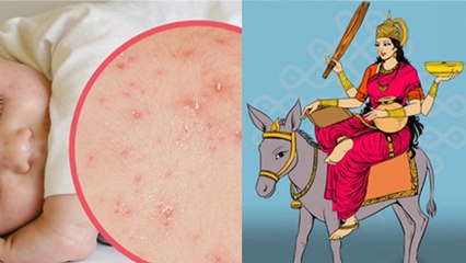 Chicken Pox Ko Mata Kyon Kahate Hain | चिकन पॉक्स को माता क्यों कहा जाता है | Boldsky