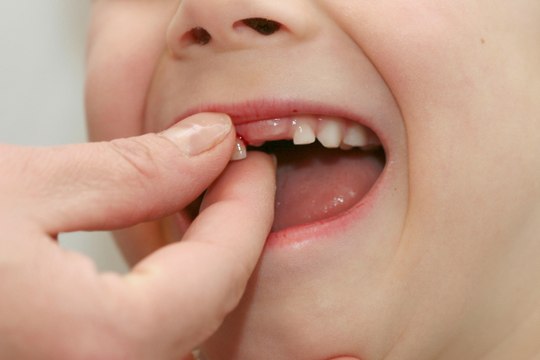 Un odontólogo explica por qué no hay que arrancarle los dientes de leche a los niños