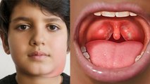 Mumps Virus In Hindi: Symptoms, Treatment, Vaccination| Mumps Kis Virus Se Hota Hai| Boldsky