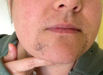 "I grew facial hair aged 13 and spent $10k trying to remove it"