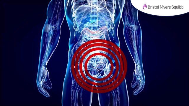 Cáncer colorrectal: Principales pruebas diagnósticas - #ExclusivoMSP