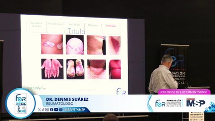 Nuevas guías de tratamiento personalizado para Enfermedad Psoriásica - #MSP