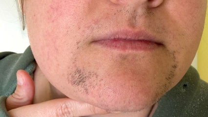 I grew facial hair aged 13 and spent $10k trying to remove it