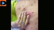 Gross Out Alert: The Most Disgusting Pimple Popping Moments Ever!
