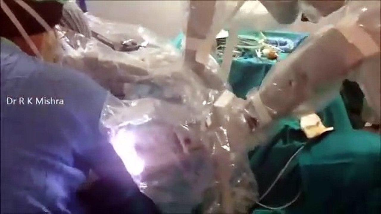 da Vinci Robotic Ovarian Cystectomy by Dr. R.K. Mishra
