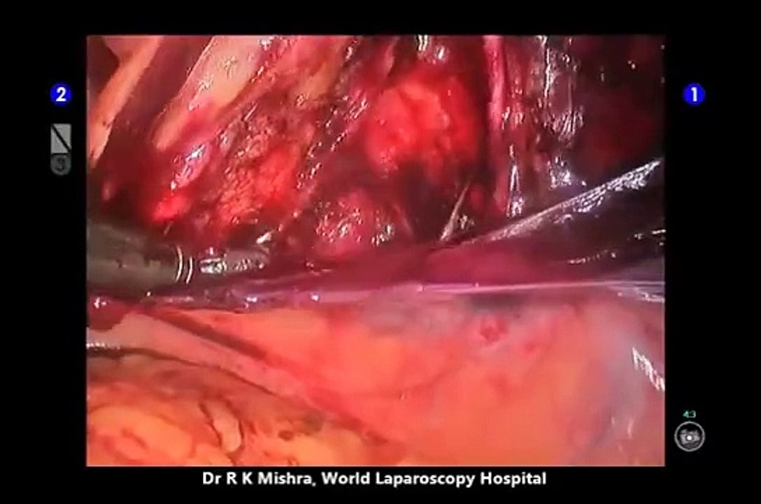 Da Vinci Robotic Repair of Bilateral Recurrent Hernia Surgery