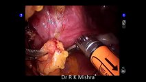 Da Vinci Robotic Surgery for Severe Abdominal Adhesion