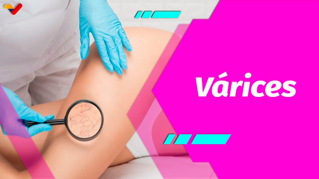 Buena Vibra | Mitos y realidades sobre las venas varicosas