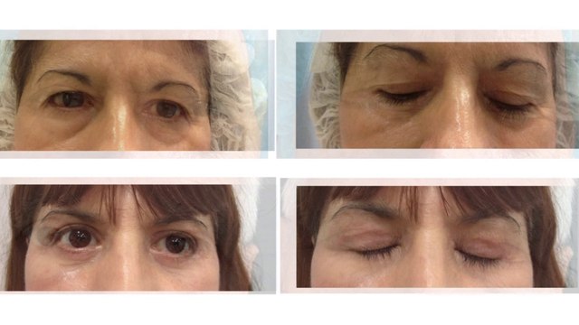 bd-parpado-caido-opciones-de-tratamiento-090424