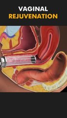 Vaginal Rejuvenation.