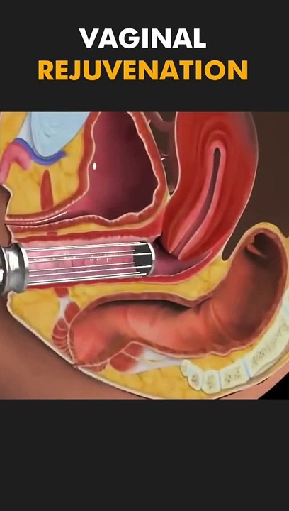 Vaginal Rejuvenation.