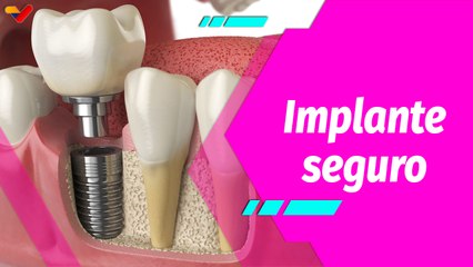 Buena Vibra | Implantes dentales: Todo lo que necesitas saber
