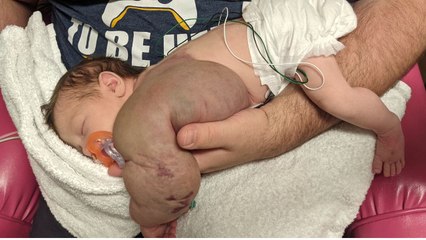 Tot born with 1kg cyst under her arm - so heavy it's making her spine curve