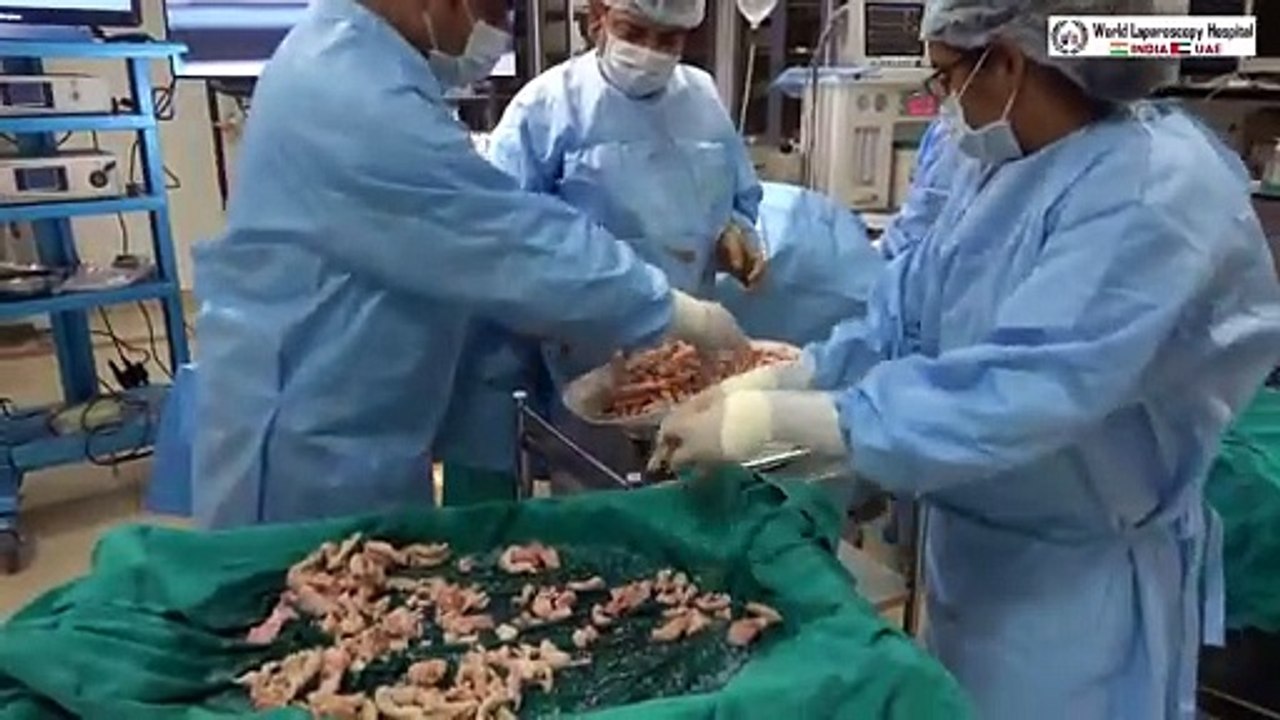 First in the World 3.5 Kg Fibroid, Ovarian Cyst, Gallbladder & Appendix removed by Laparoscopy