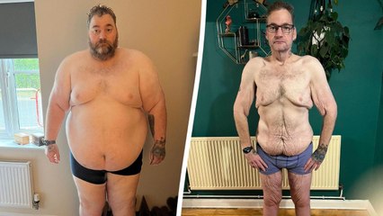 Man who lost 24 stone faces paying £40k to go private for excess skin removal