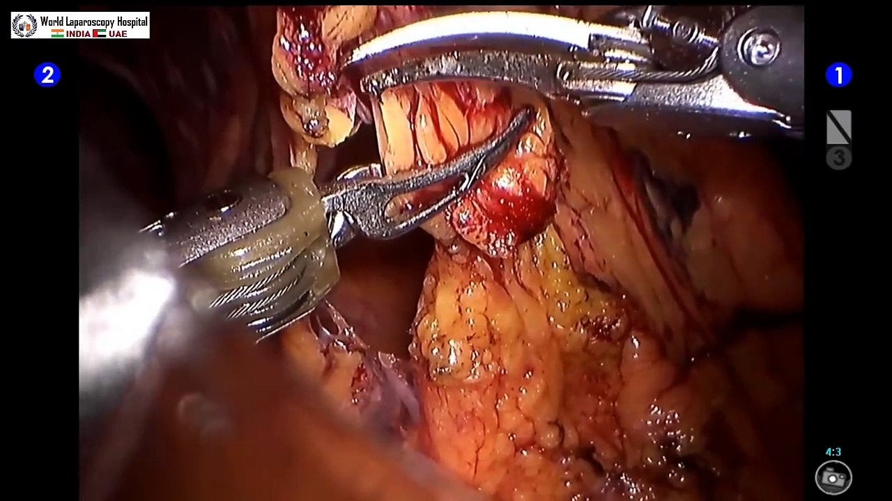 Davinci Robotic Adhesiolysis Surgery with Application of Interceed