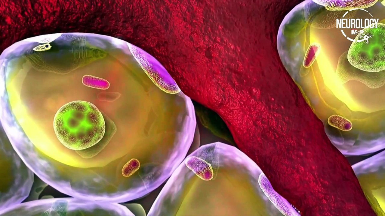 Investigaciones actuales sobre parkinson - #ExclusivoMSP