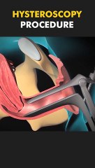 Hysteroscopy Procedure 3D Animation