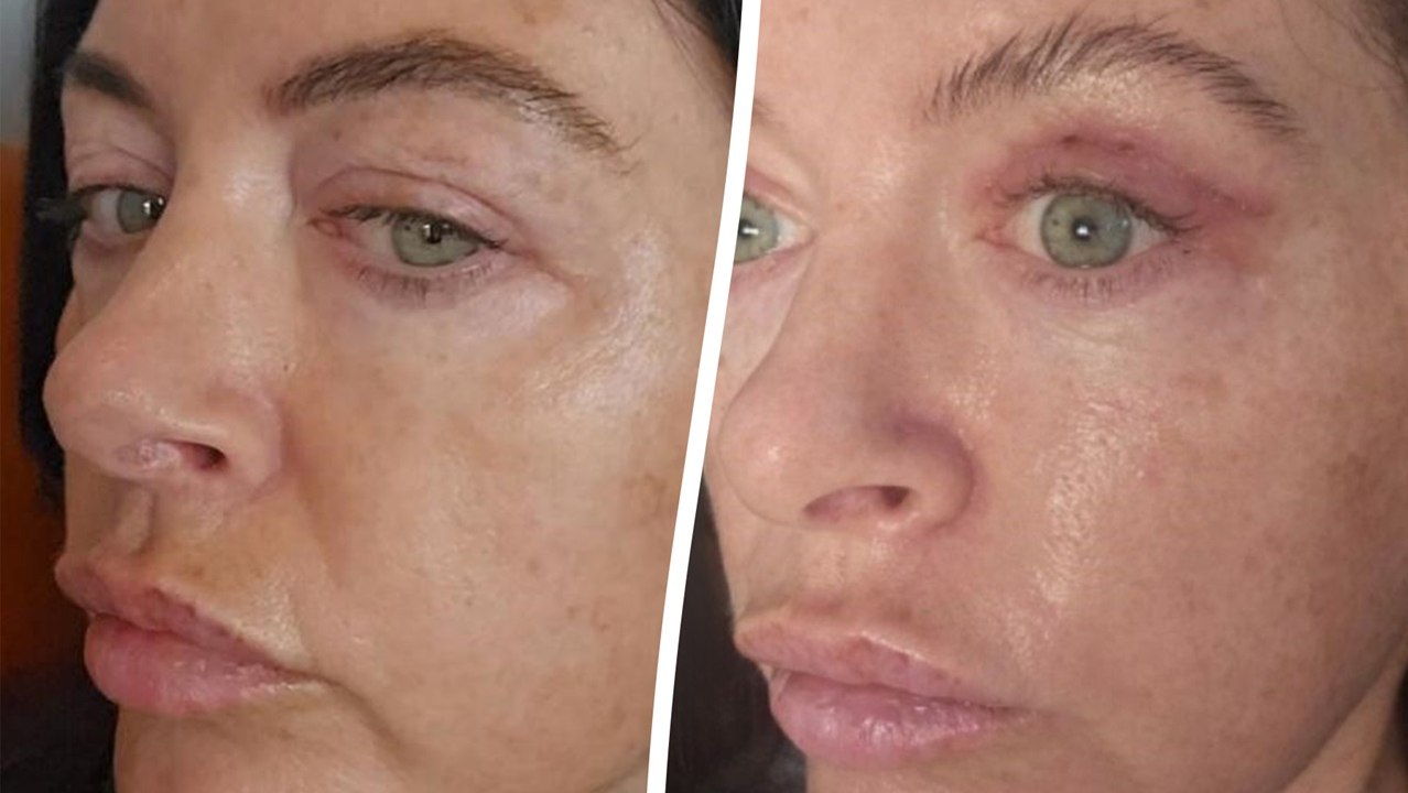 Beautician spent £1.2k on eyelid surgery so she can do eyeliner properly