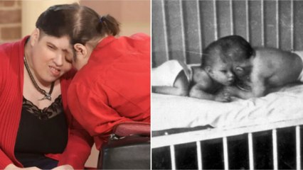 Mort des jumeaux siamois les plus âgés du monde, Lori et Georges Schappell, à 62 ans