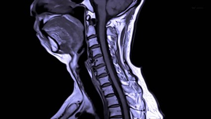 Des avancées en neuroscience pourrait mener à de nouveaux traitements de la colonne vertéb