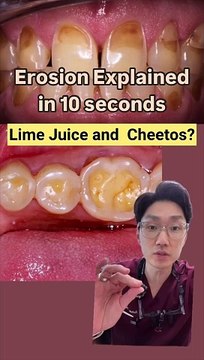 Riverside dentist Dr. Andrew Choi Reveals the Impact of Acidic Foods on Dental Health