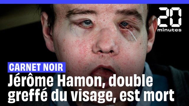 Mort de Jérôme Hamon, l’homme aux deux greffes de visage