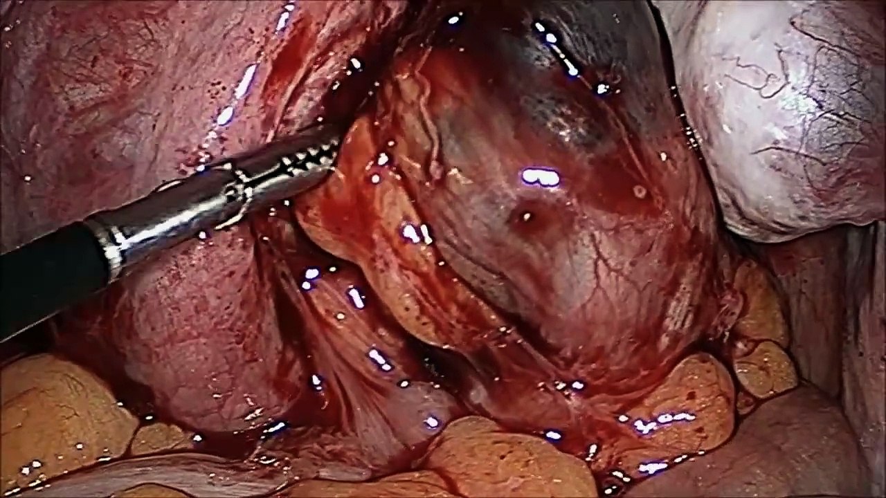 Diagnosis of intestinal endometriosis by laparoscopic surgery