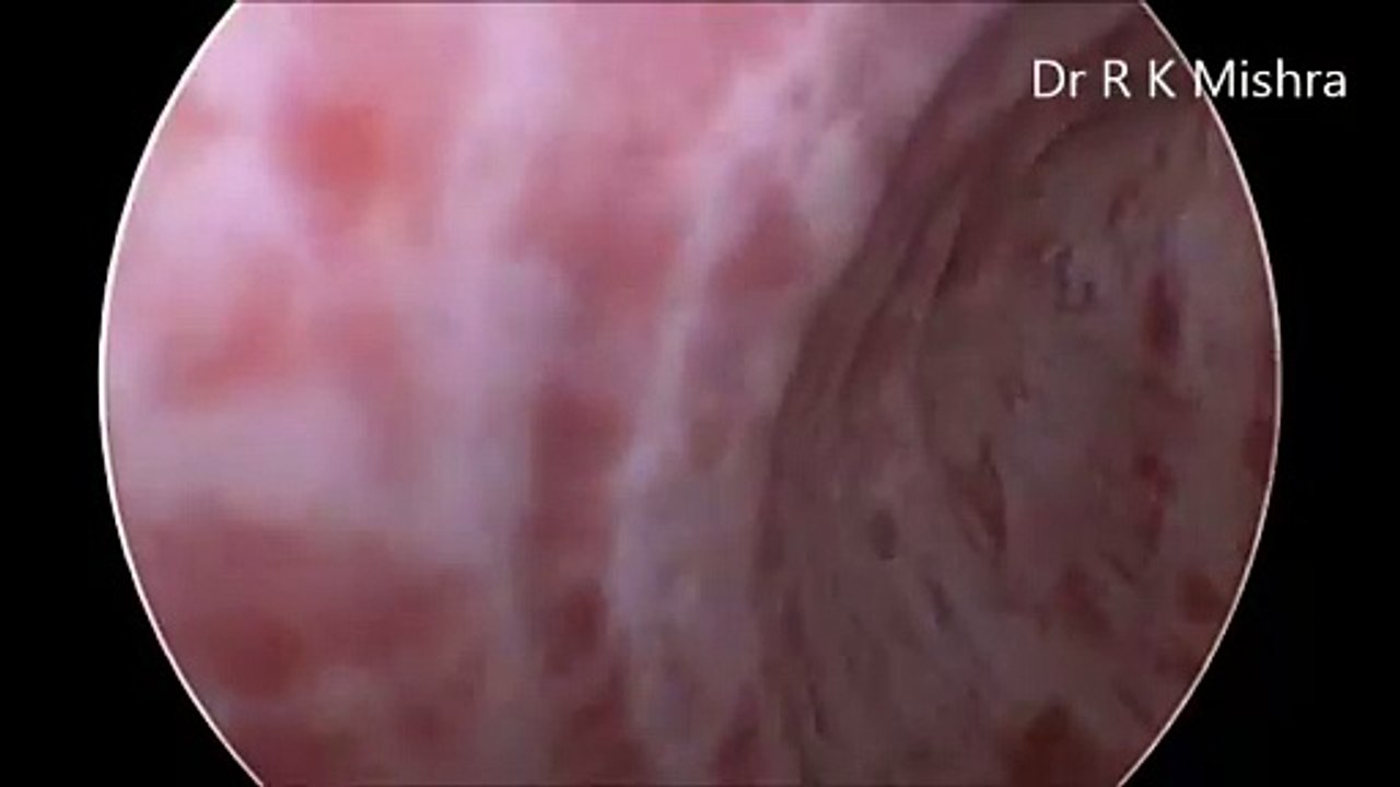 Diagnostic Cystoscopy