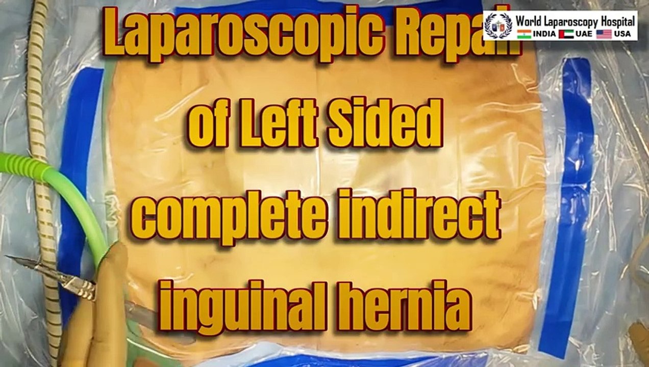 Laparoscopic Repair of LeftSided Complete Indirect Inguinal Hernia Skin to Skin Surgery Video