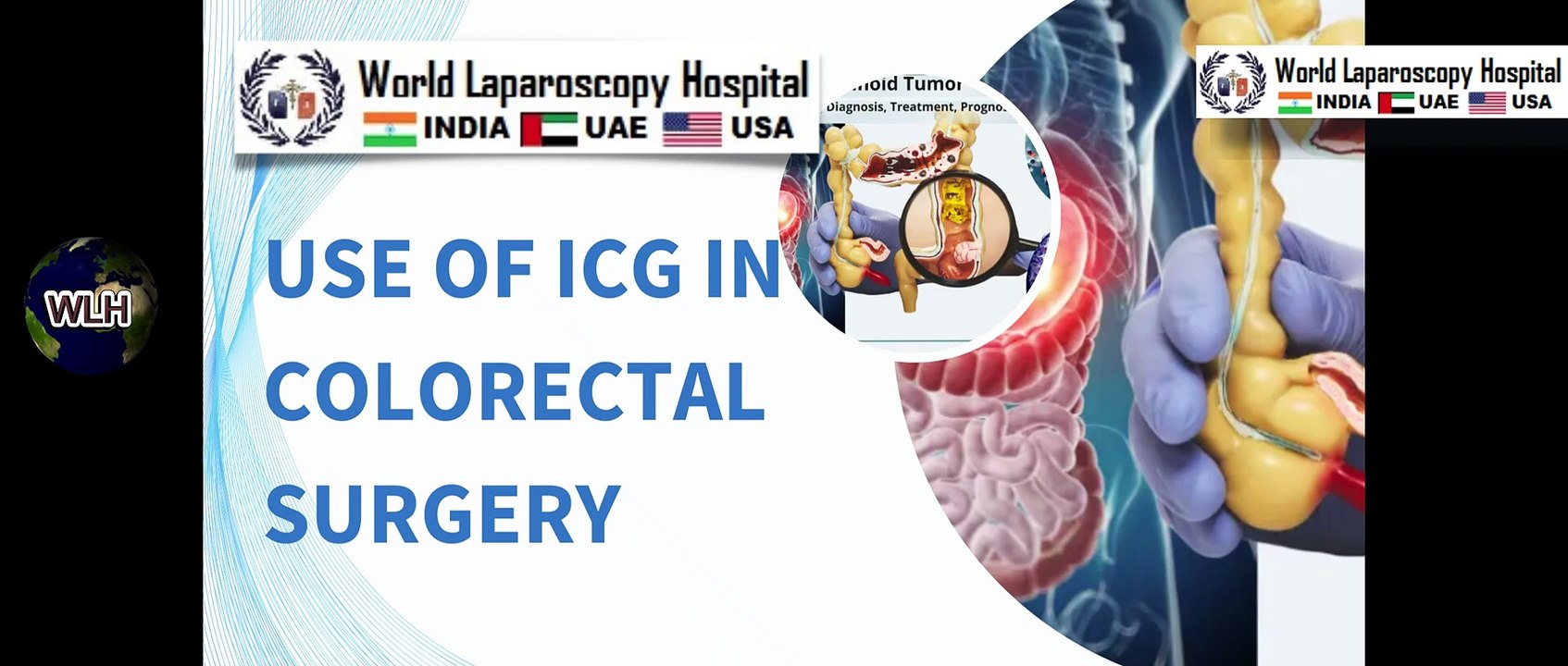 Exploring the Use of Indocyanine Green ICG in Colorectal Surgery  Steven D Wexner