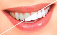 Ortodontista explica quais são os principais benefícios do clareamento dental