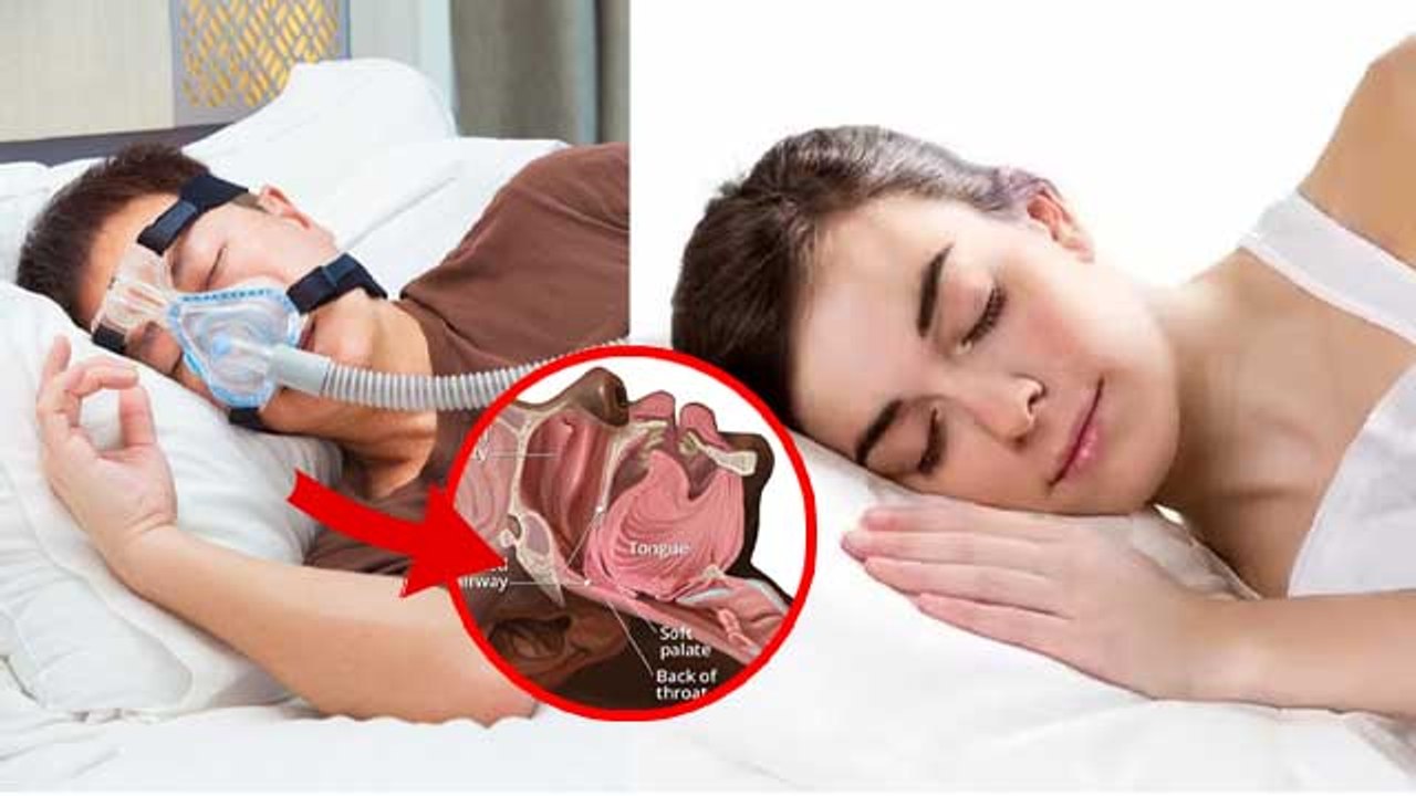 Sleep Apnea Se Kese Bache |What Causes Sleep Ap...
