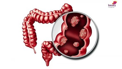 Colonoscopy - Symptoms & Procedure | Tamil
