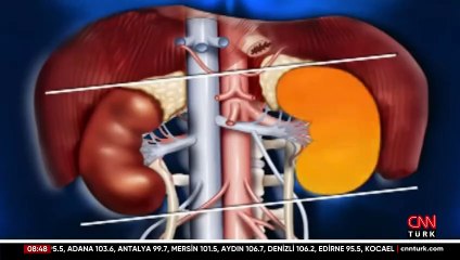 Böbrek taşında bu belirtilere dikkat